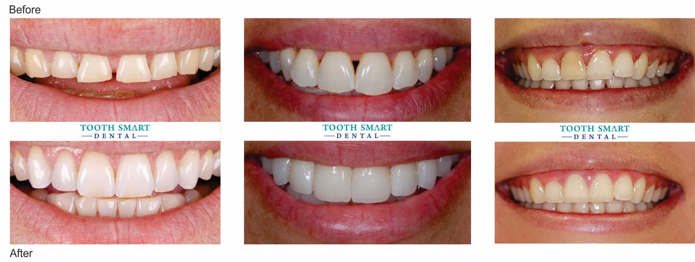 Porcelain Veneers