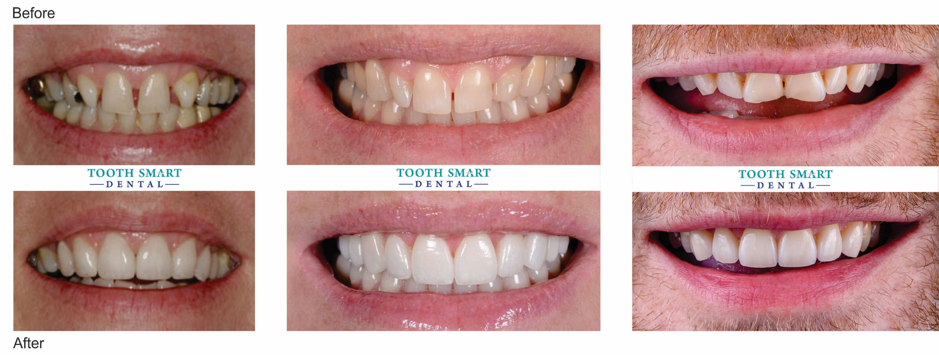 Porcelain Veneers