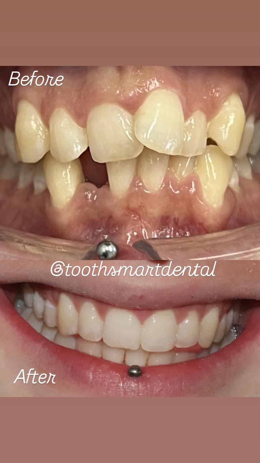 Teeth Whitening Result 1
