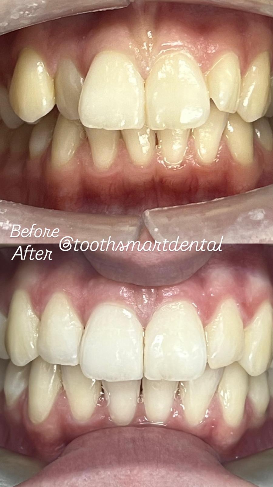 Teeth Whitening Result 2