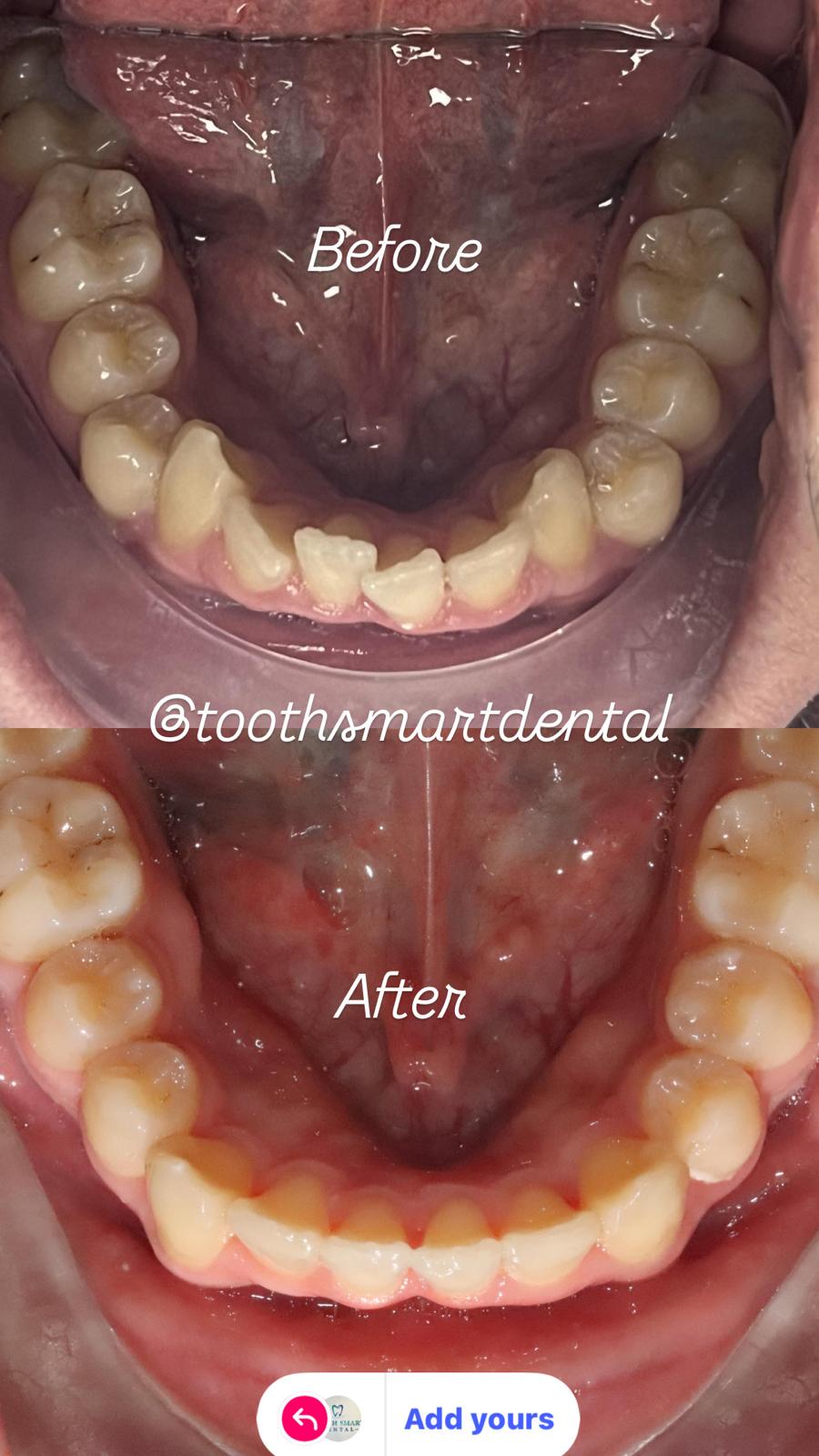 Teeth Whitening Result 3
