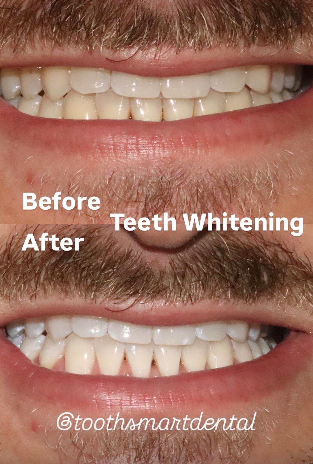 Teeth Whitening Result 1