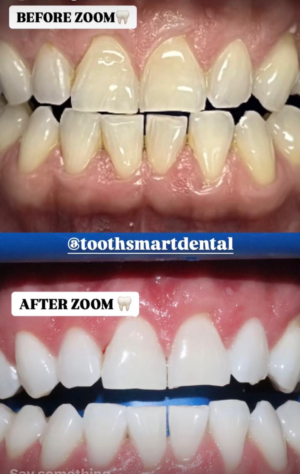 Teeth Whitening Result 2