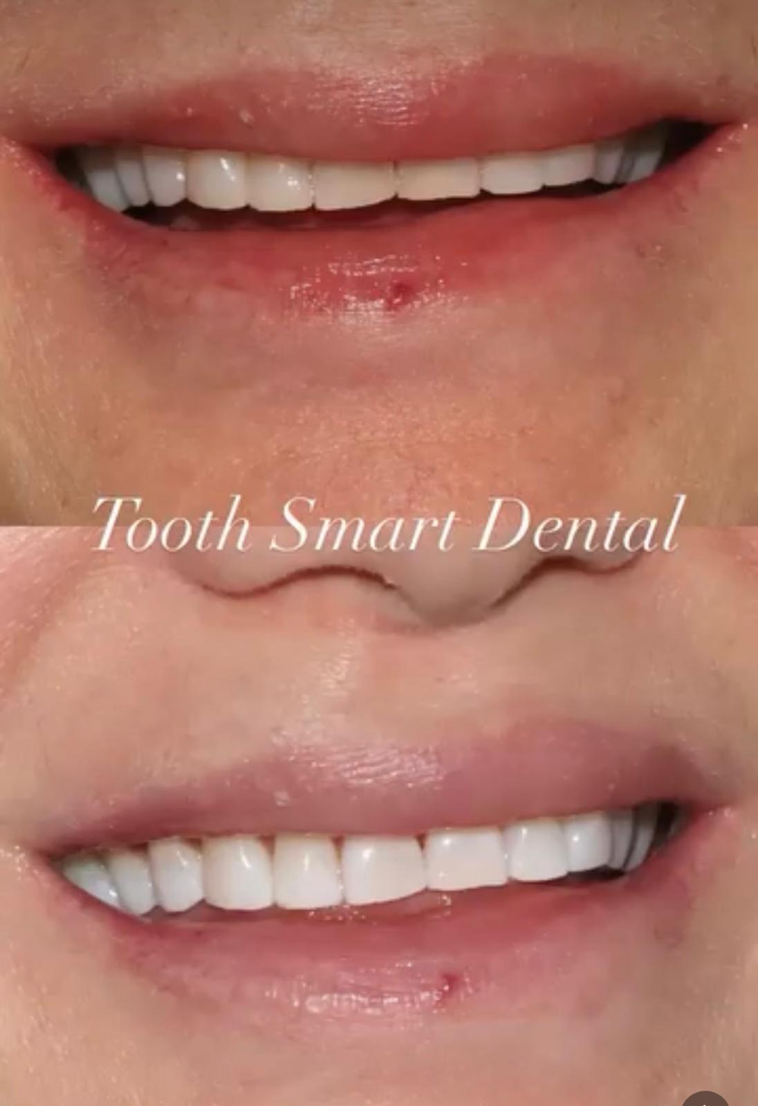 Teeth Whitening Result 3
