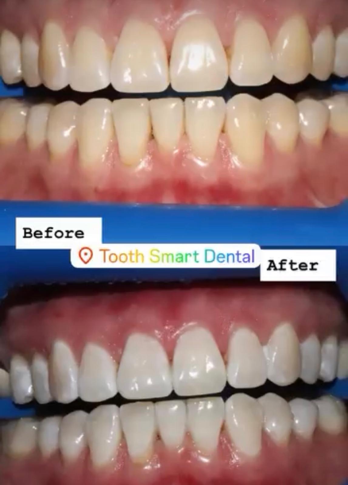 Teeth Whitening Result 5
