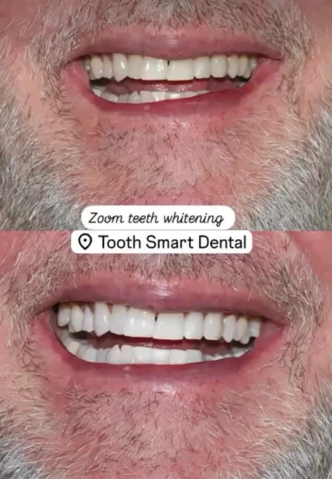Teeth Whitening Result 6