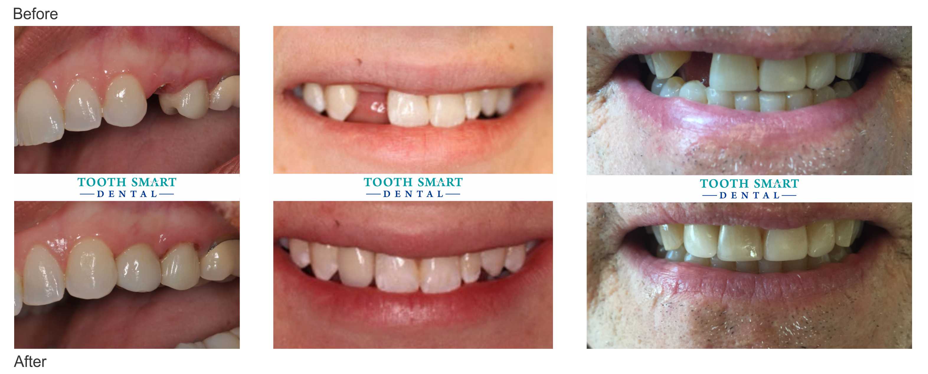 Implant Before and After Teeth